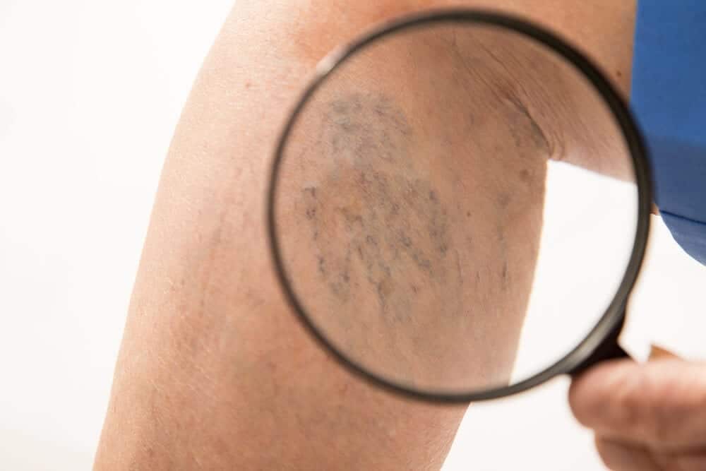 What Are Spider Veins