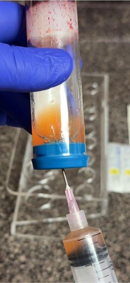 Drawing PRP from the spun FDA-cleared kit